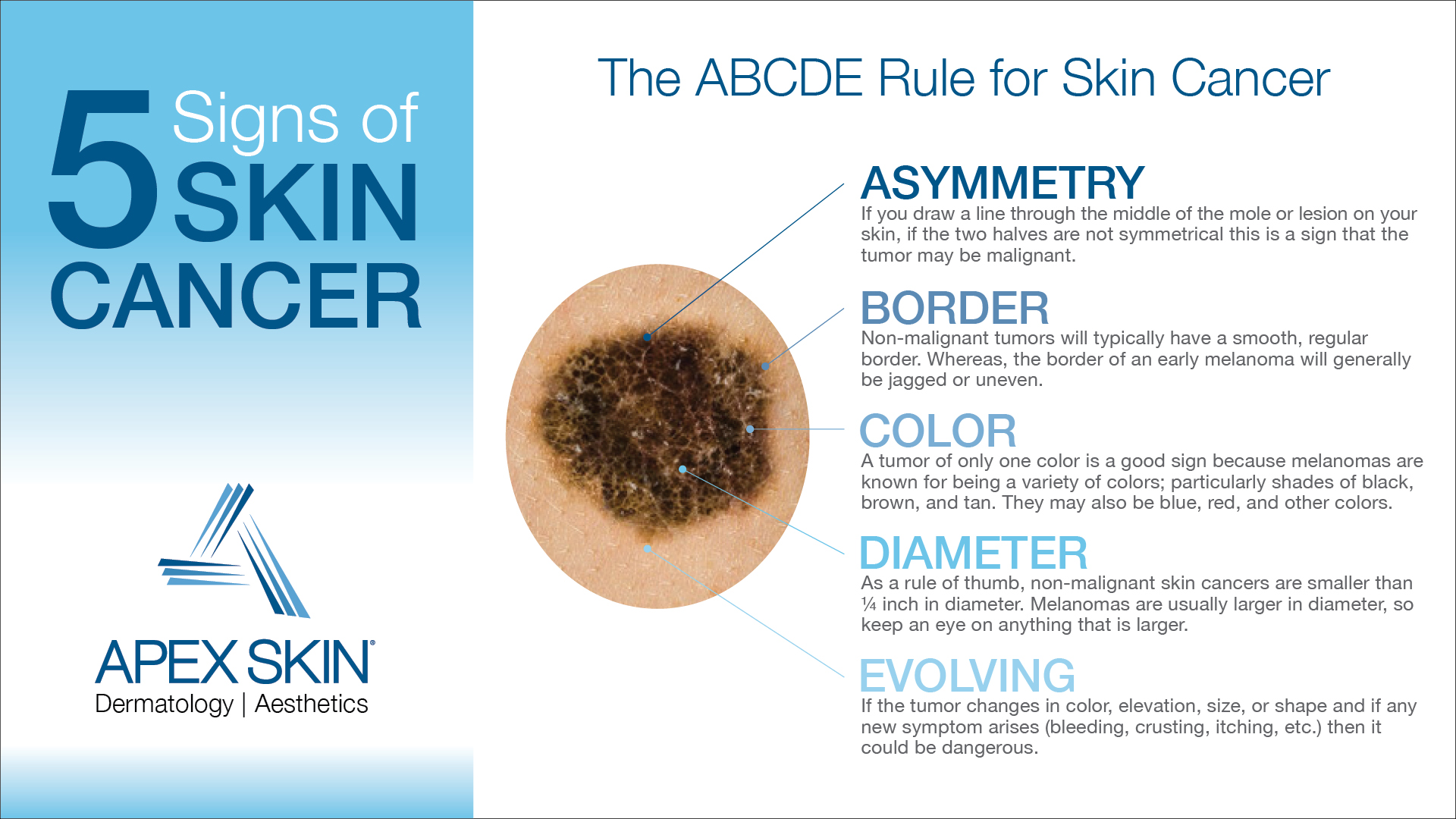 5 Signs of Skin Cancer ABCDE Rule Infographic