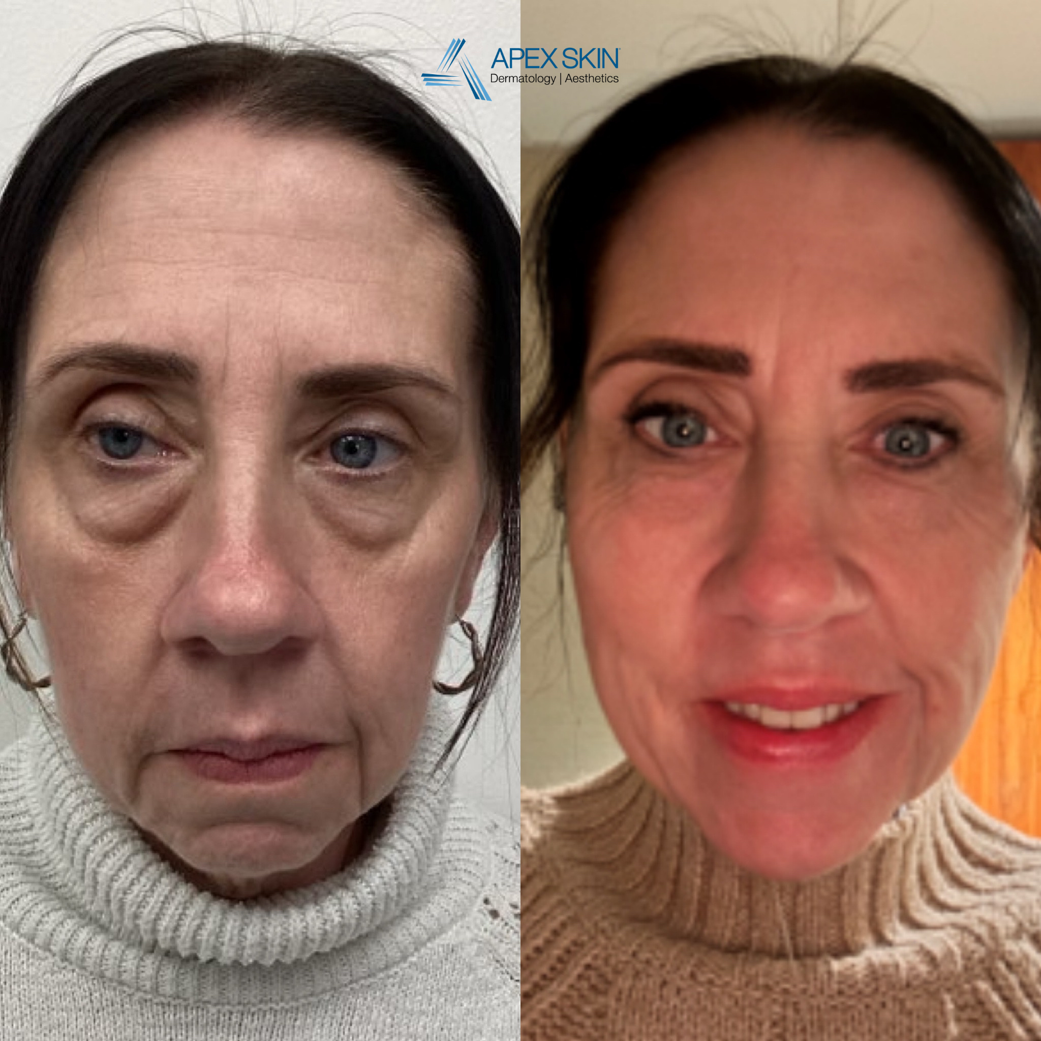 Weightloss patient before and after aesthetics treatment.