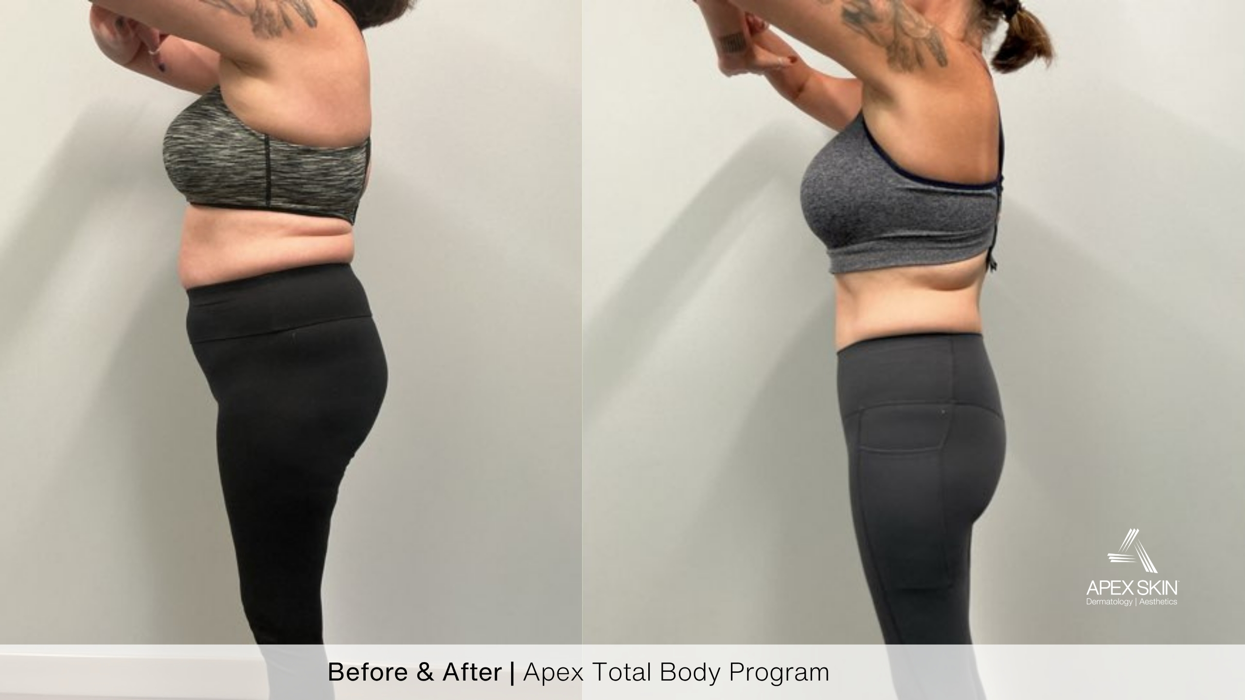 weight loss injection